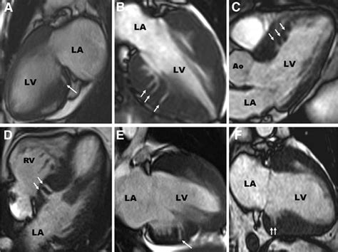 lv crypt|left ventricular myocardial mass.